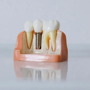 Who Is a Good Candidate for Dental Implants?
