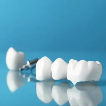 Signs You May Need a Dental Crown in Greeley
